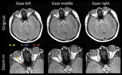 The Impact of Optic Nerve Movement on Intracranial Radiation Treatment